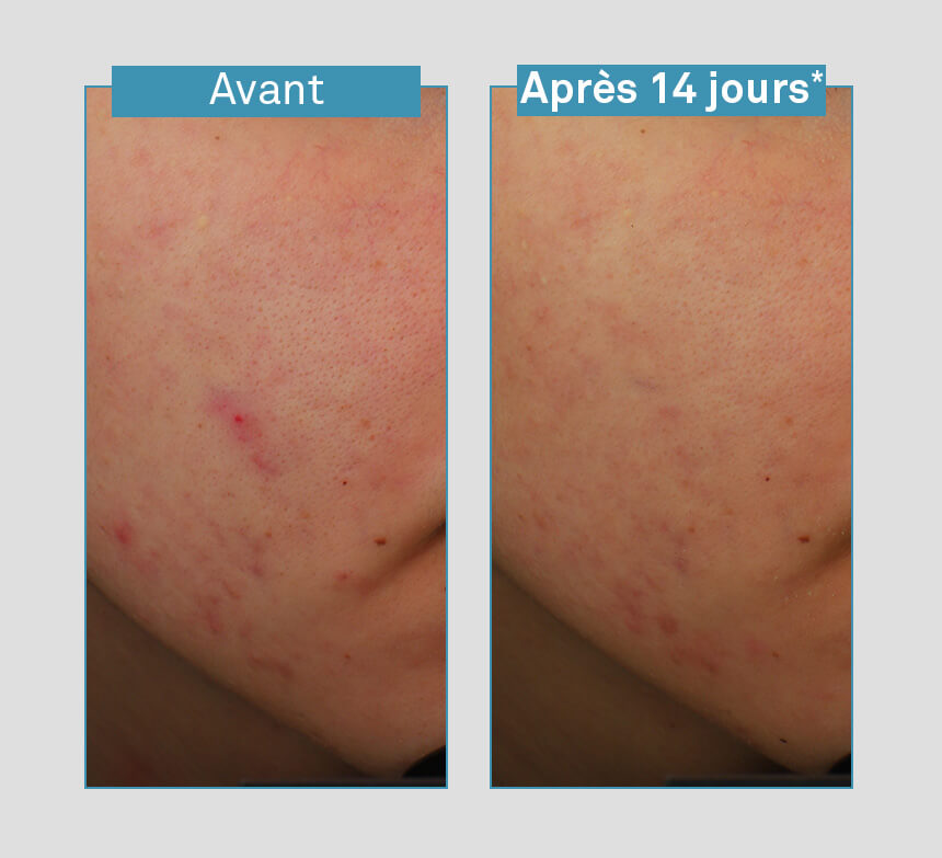 serum-anti-imperfections