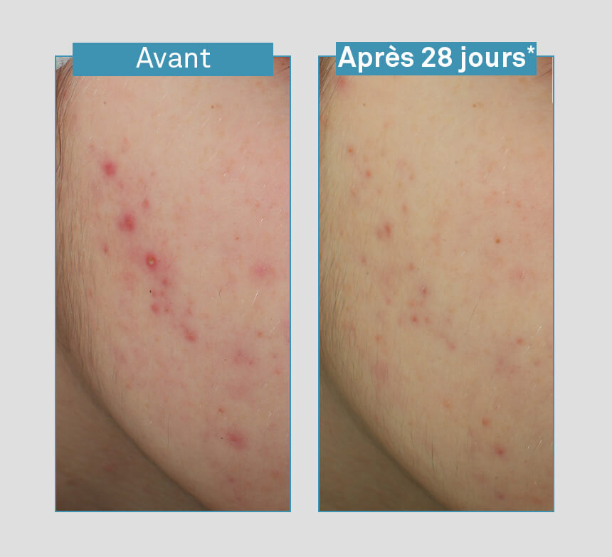 serum-anti-imperfections